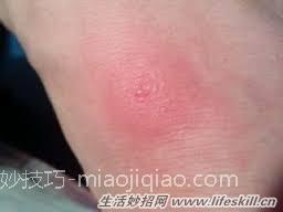 被蚊子叮咬后起水泡了怎么办？ 